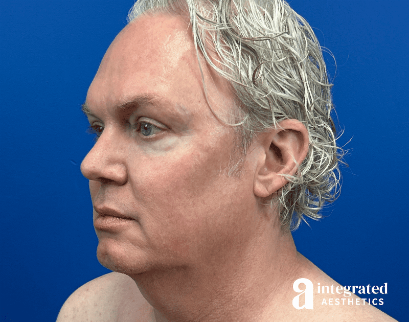 Facelift & Neck Lift Before & After Gallery - Patient 313601 - Image 5