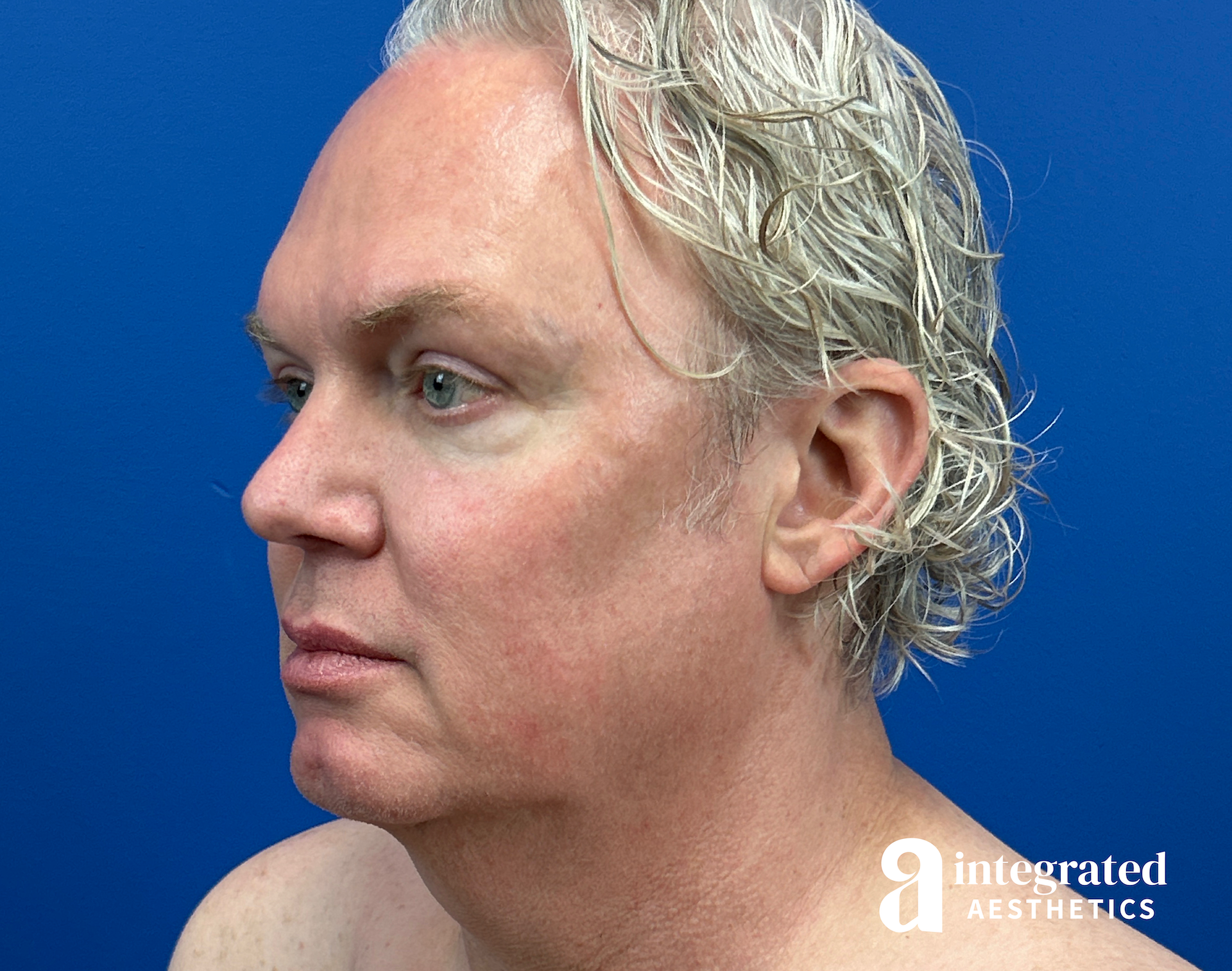 Facelift & Neck Lift Before & After Gallery - Patient 313601 - Image 5