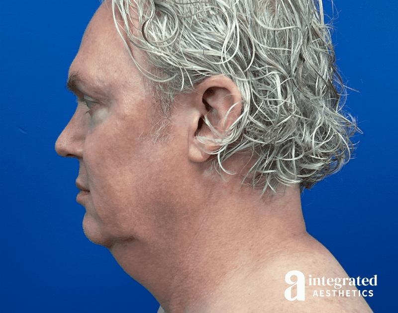 Facelift & Neck Lift Before & After Gallery - Patient 313601 - Image 7