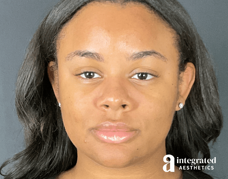 Wrinkle Relaxers Before & After Gallery - Patient 346461 - Image 1