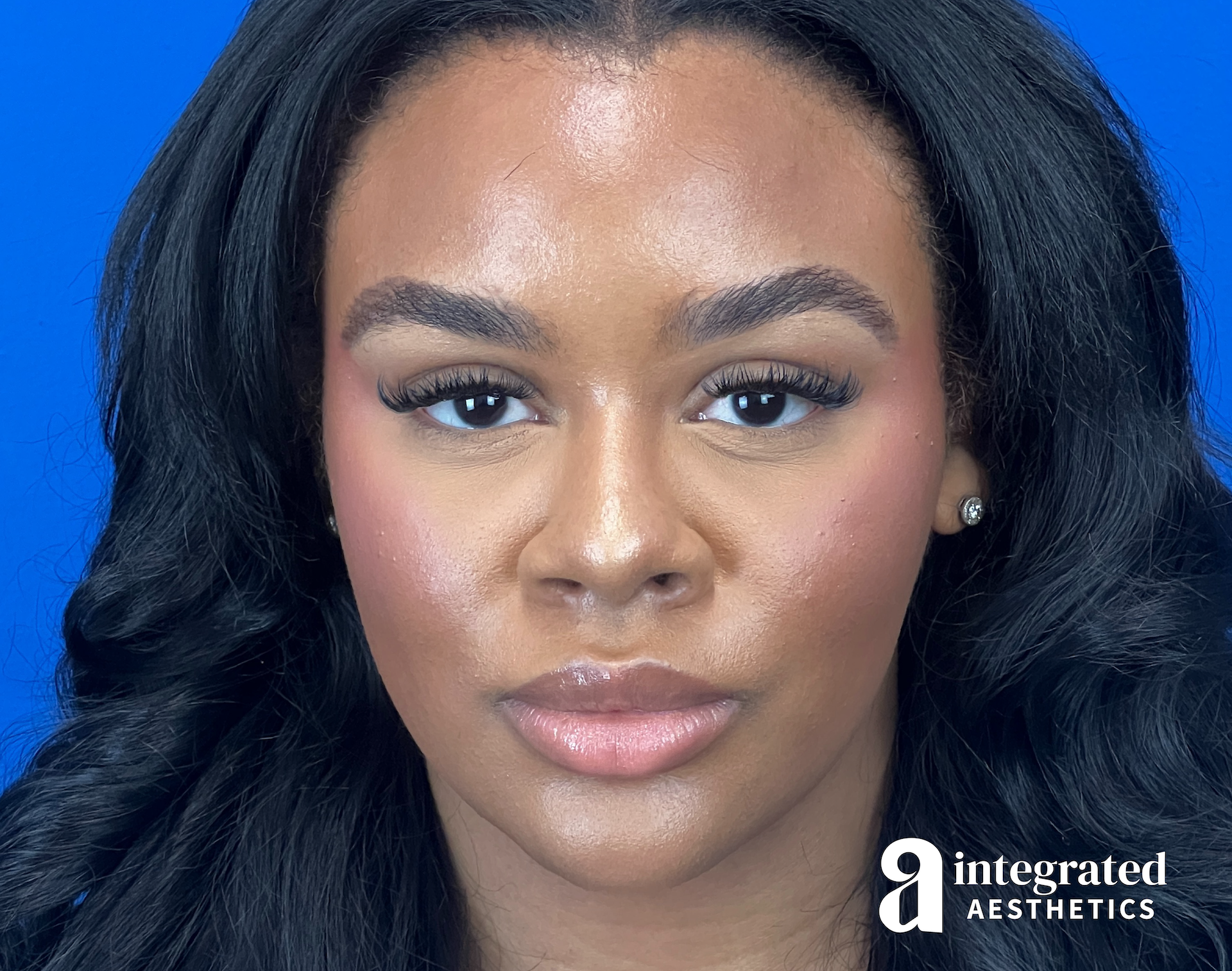 Wrinkle Relaxers Before & After Gallery - Patient 346461 - Image 2