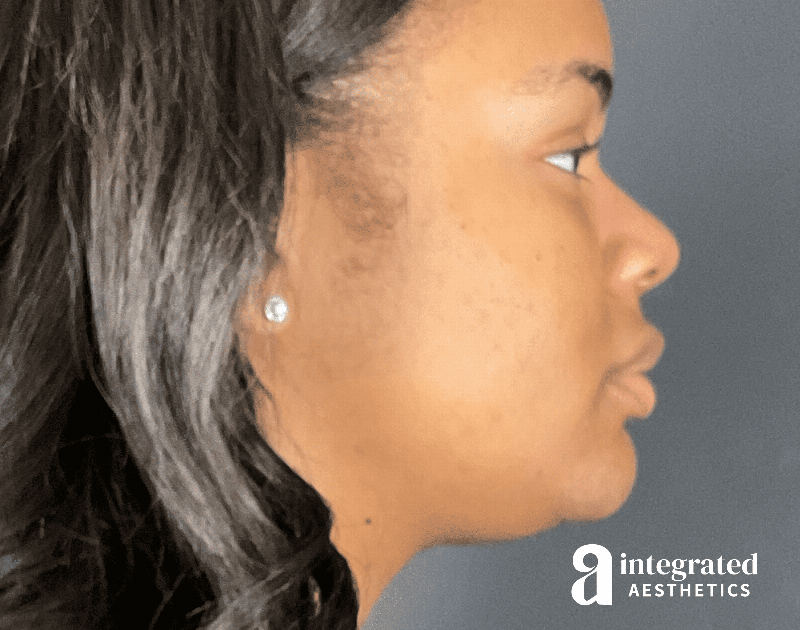 Wrinkle Relaxers Before & After Gallery - Patient 346461 - Image 3