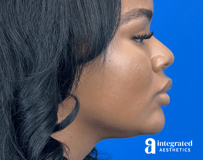 Wrinkle Relaxers Before & After Gallery - Patient 346461 - Image 4