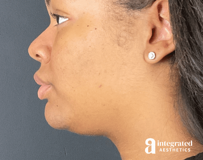 Wrinkle Relaxers Before & After Gallery - Patient 346461 - Image 5