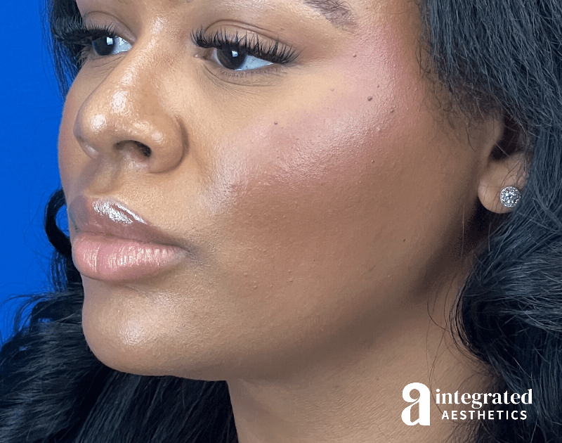 Wrinkle Relaxers Before & After Gallery - Patient 346461 - Image 8