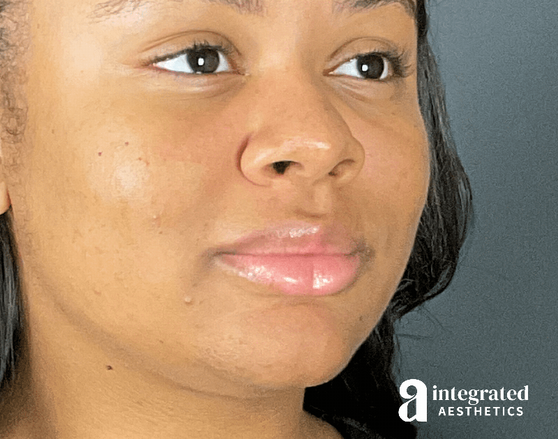 Wrinkle Relaxers Before & After Gallery - Patient 346461 - Image 9