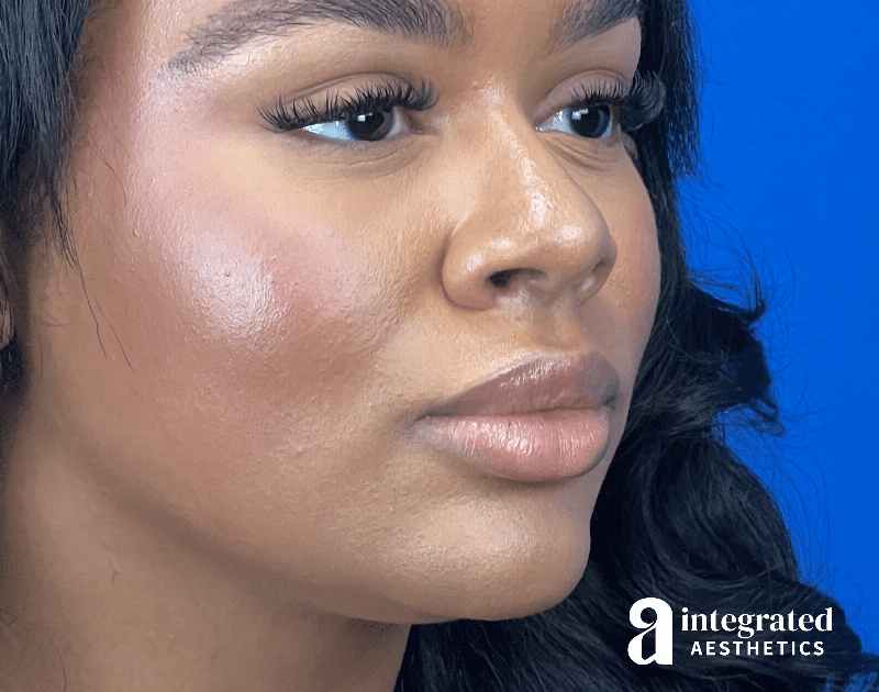 Wrinkle Relaxers Before & After Gallery - Patient 346461 - Image 10