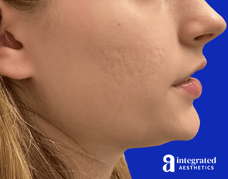 Accutane Before & After Gallery - Patient 375374 - Image 2