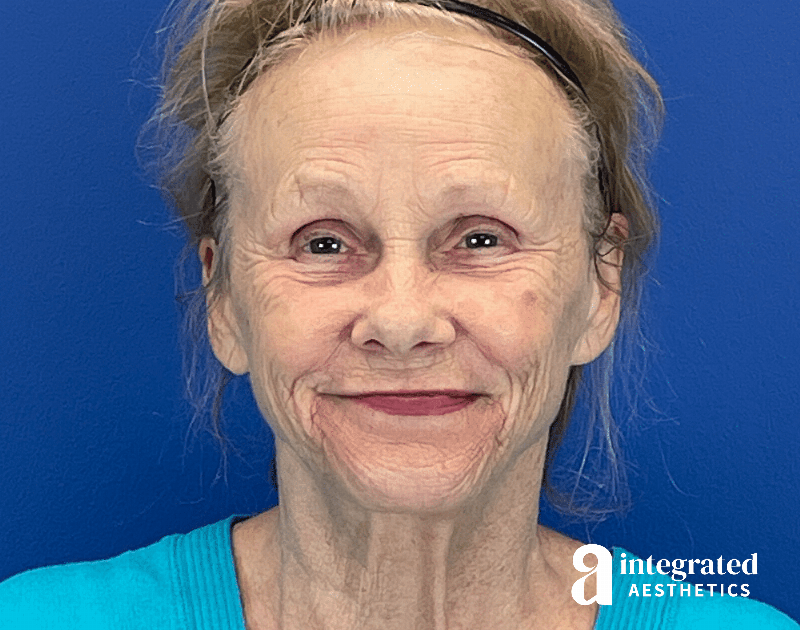 Chemical Peel Before & After Gallery - Patient 336701 - Image 1