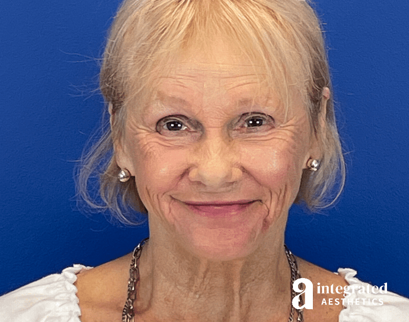 Chemical Peel Before & After Gallery - Patient 336701 - Image 2