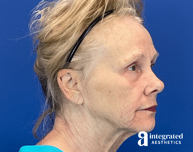 Chemical Peel Before & After Gallery - Patient 336701 - Image 3