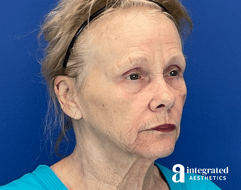 Chemical Peel Before & After Gallery - Patient 336701 - Image 7