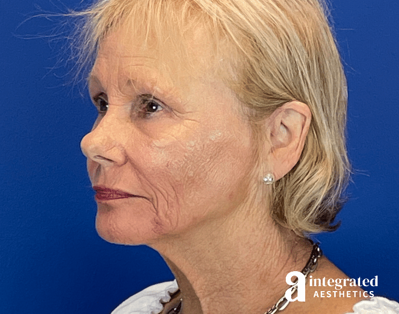 Chemical Peel Before & After Gallery - Patient 336701 - Image 10