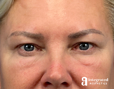 Blepharoplasty Before & After Gallery - Patient 190095 - Image 1