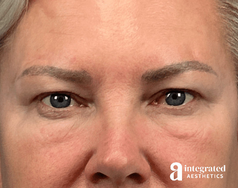 Blepharoplasty Before & After Gallery - Patient 190095 - Image 1