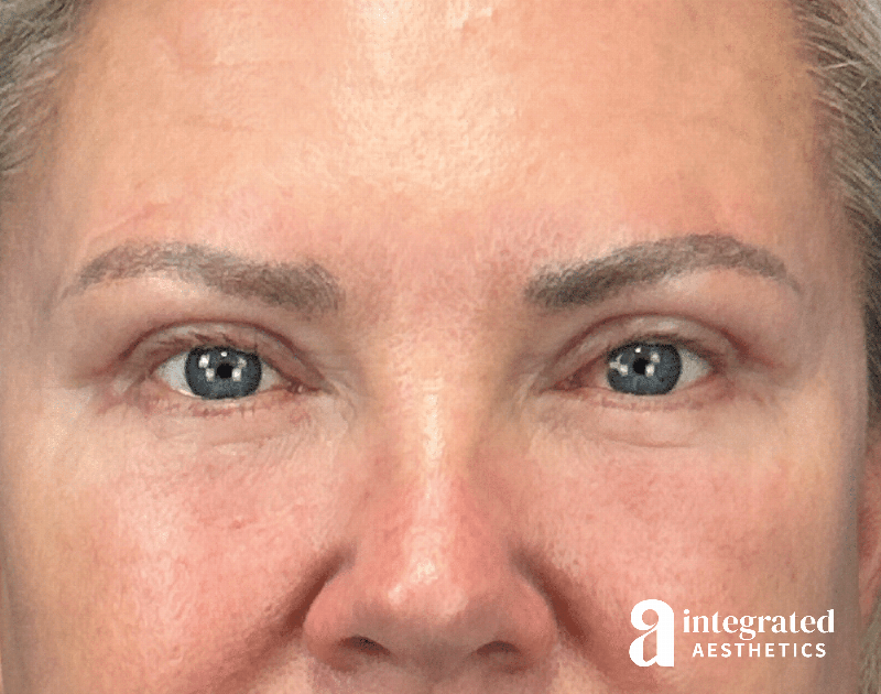 Blepharoplasty Before & After Gallery - Patient 190095 - Image 2