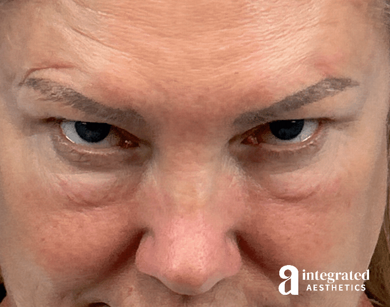 Blepharoplasty Before & After Gallery - Patient 190095 - Image 3