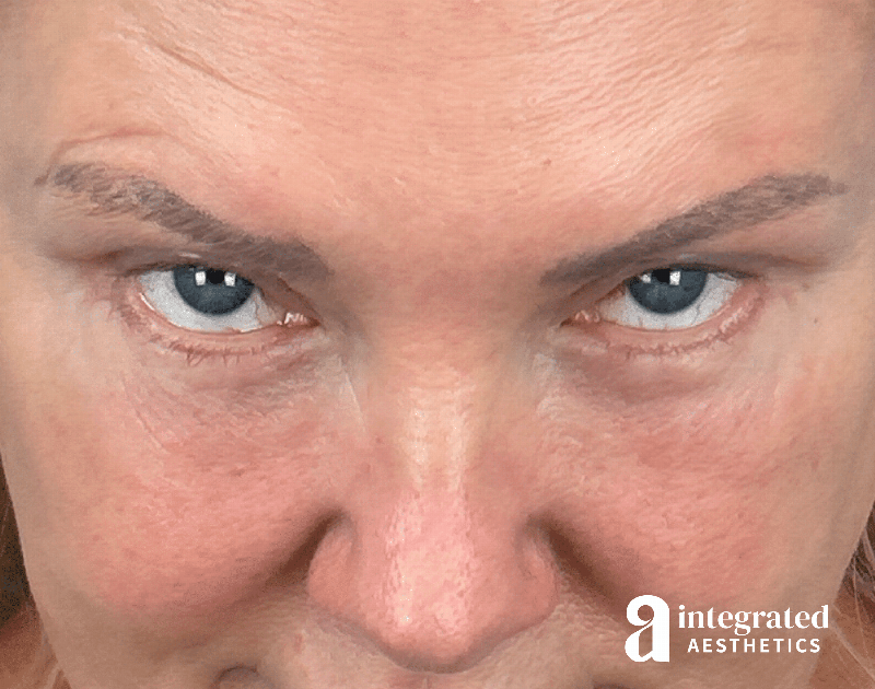 Blepharoplasty Before & After Gallery - Patient 190095 - Image 4