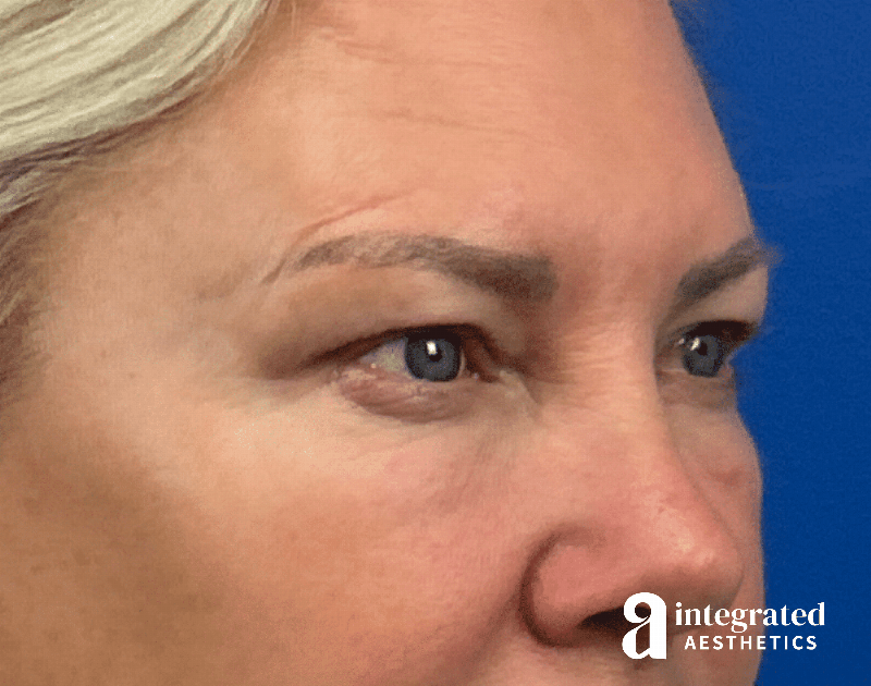 Blepharoplasty Before & After Gallery - Patient 190095 - Image 7