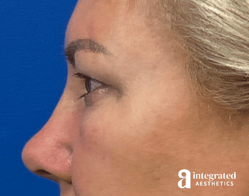 Blepharoplasty Before & After Gallery - Patient 190095 - Image 9