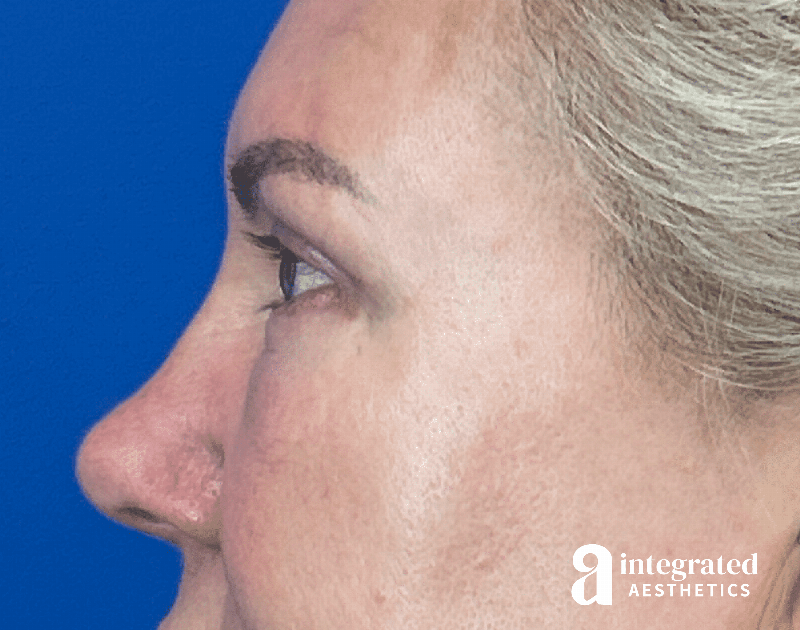 Blepharoplasty Before & After Gallery - Patient 190095 - Image 10