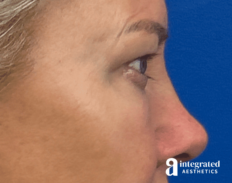 Blepharoplasty Before & After Gallery - Patient 190095 - Image 11