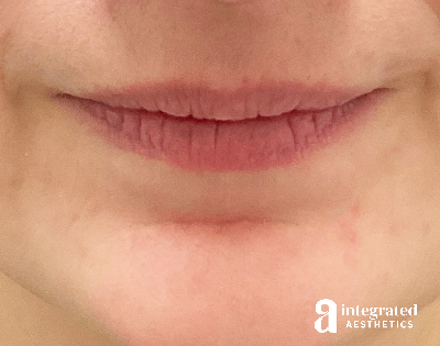 Lip Filler Before & After Gallery - Patient 164545 - Image 1