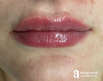 Lip Filler Before & After Gallery - Patient 164545 - Image 2