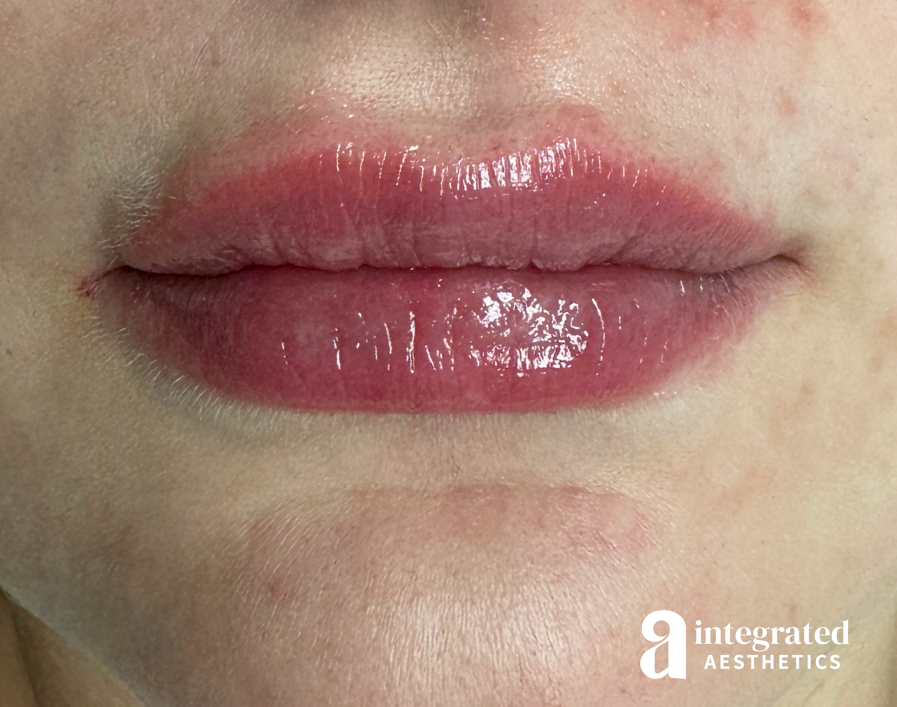 Lip Filler Before & After Gallery - Patient 164545 - Image 2