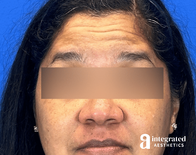 Botox Before & After Gallery - Patient 131184 - Image 1