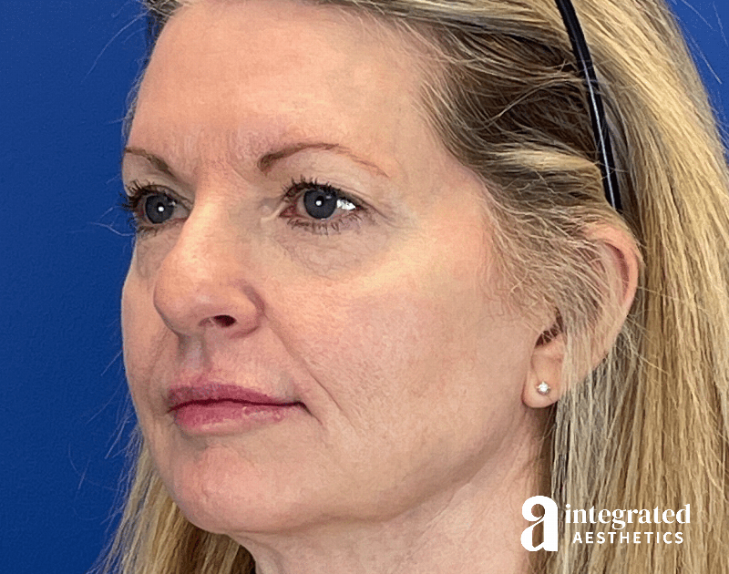 Dermal Fillers Before & After Gallery - Patient 881252 - Image 3