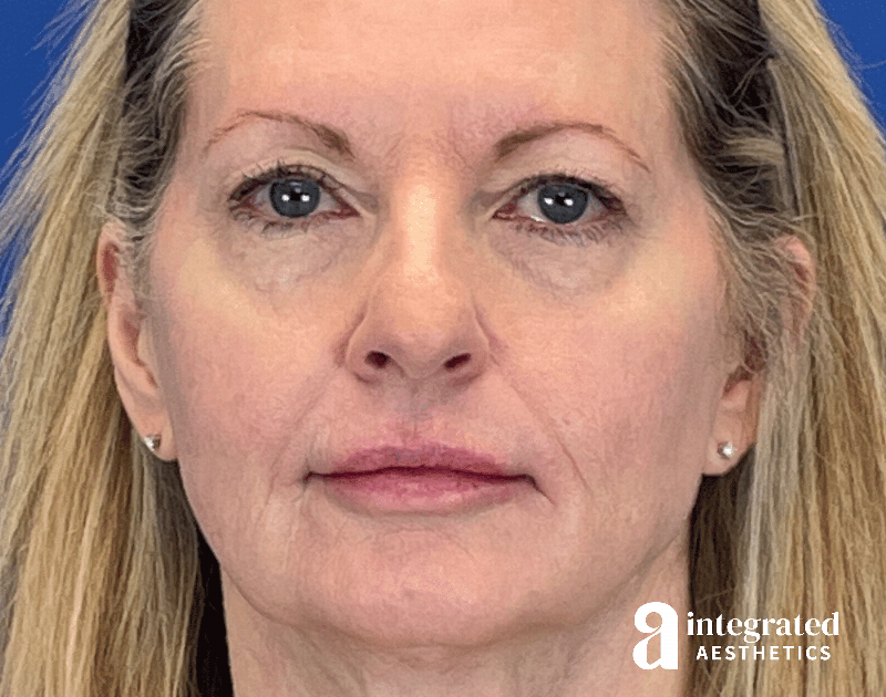 Dermal Fillers Before & After Gallery - Patient 881252 - Image 1