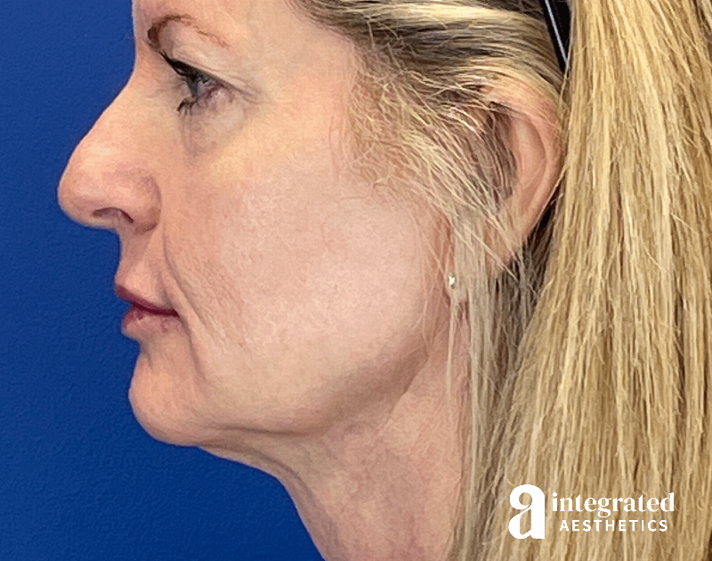 Dermal Fillers Before & After Gallery - Patient 881252 - Image 7