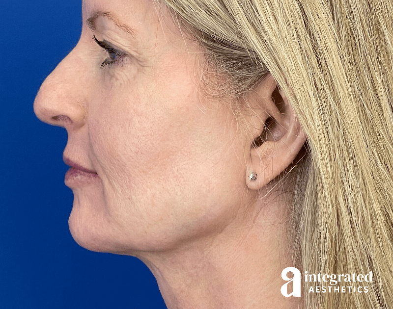 Dermal Fillers Before & After Gallery - Patient 881252 - Image 8