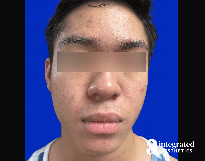 Accutane Before & After Gallery - Patient 276626 - Image 1