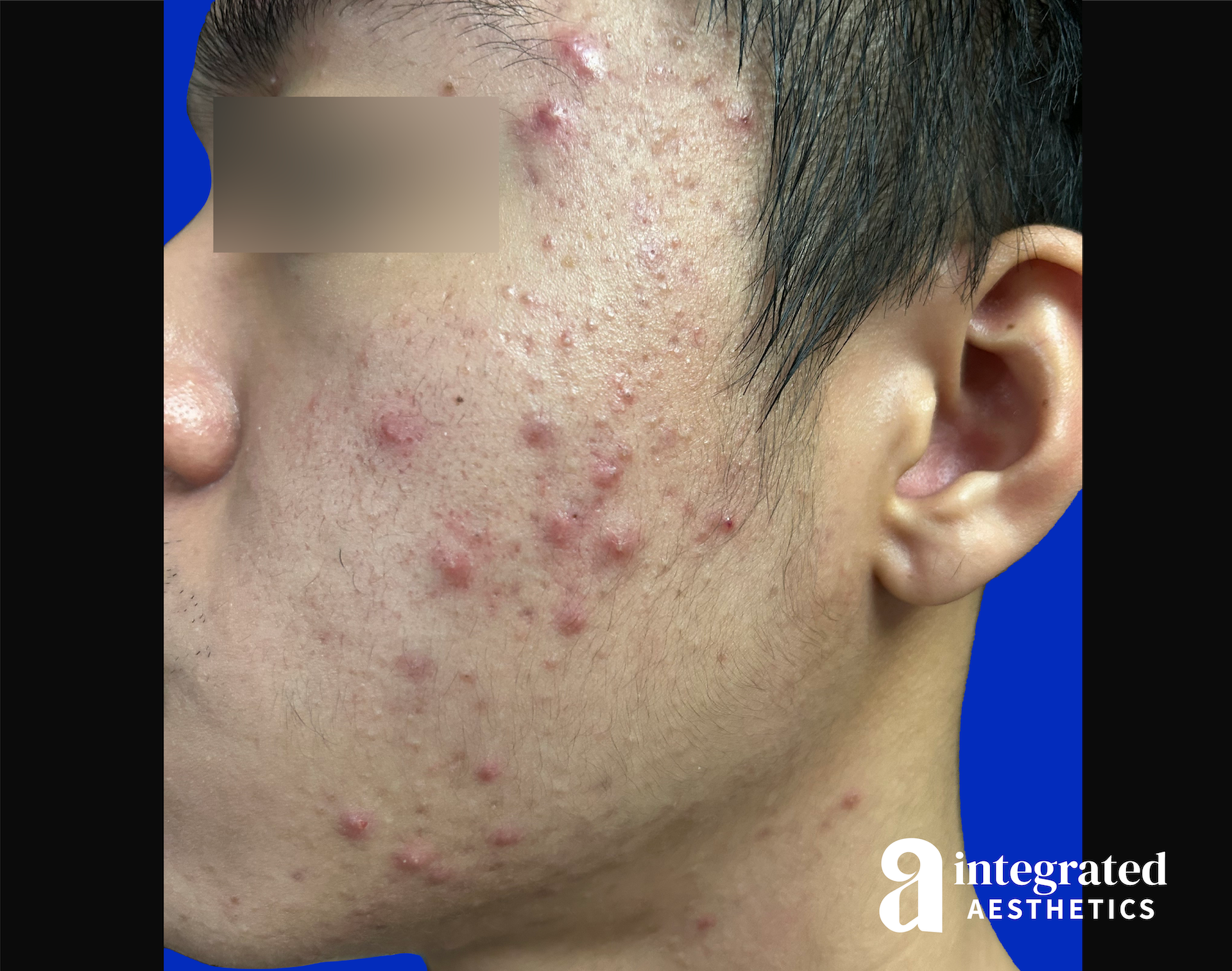 Accutane Before & After Gallery - Patient 276626 - Image 3