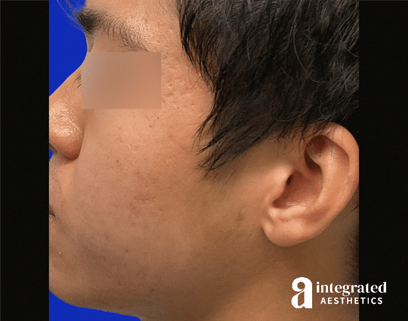 Accutane Before & After Gallery - Patient 276626 - Image 4