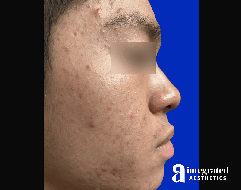 Accutane Before & After Gallery - Patient 276626 - Image 5