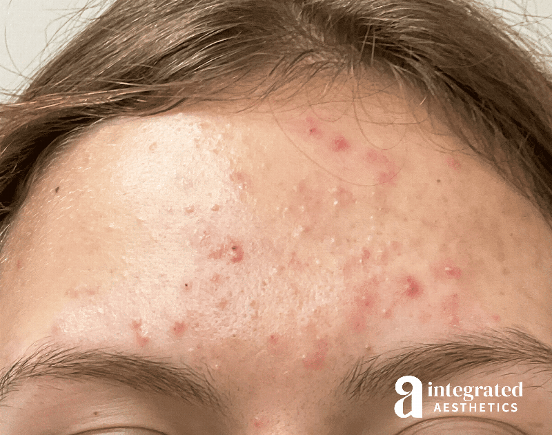 Accutane Before & After Gallery - Patient 643381 - Image 1