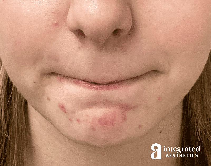 Accutane Before & After Gallery - Patient 643381 - Image 3