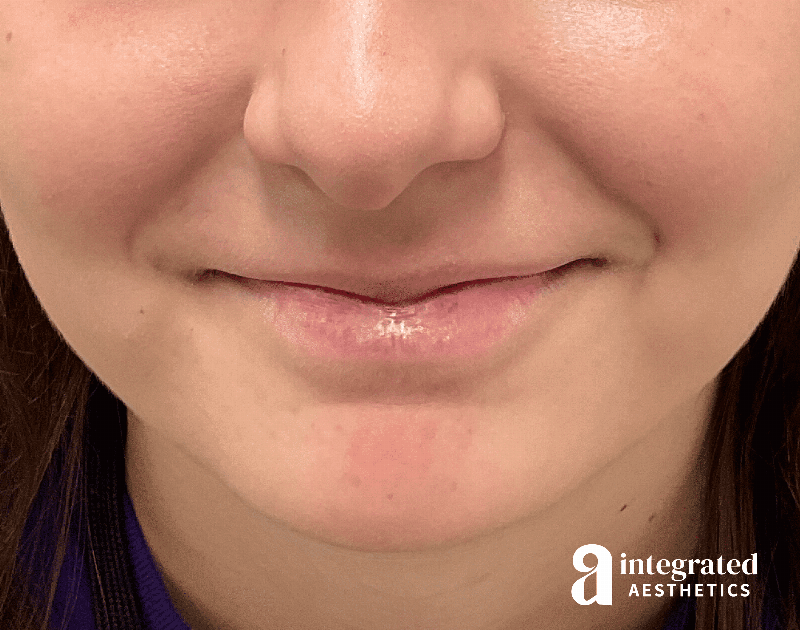 Accutane Before & After Gallery - Patient 643381 - Image 4