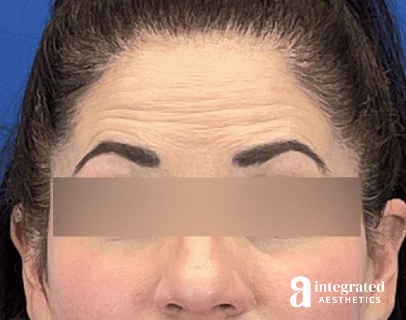 Botox Before & After Gallery - Patient 278872 - Image 1