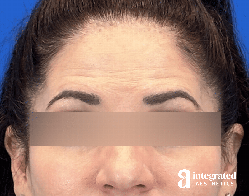 Botox Before & After Gallery - Patient 278872 - Image 2