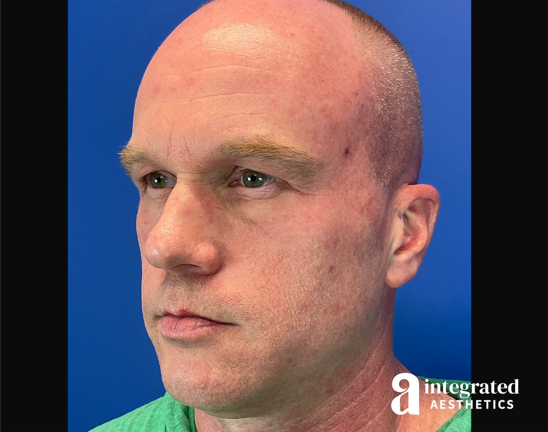 Chemical Peel Before & After Gallery - Patient 197177 - Image 3