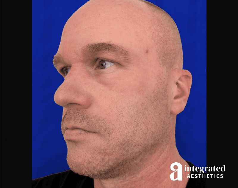 Chemical Peel Before & After Gallery - Patient 197177 - Image 4