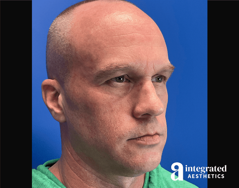 Chemical Peel Before & After Gallery - Patient 197177 - Image 5