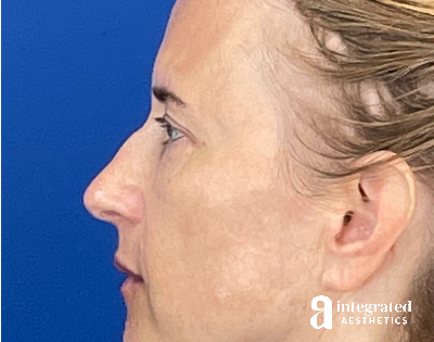 Dermal Fillers Before & After Gallery - Patient 421717 - Image 1