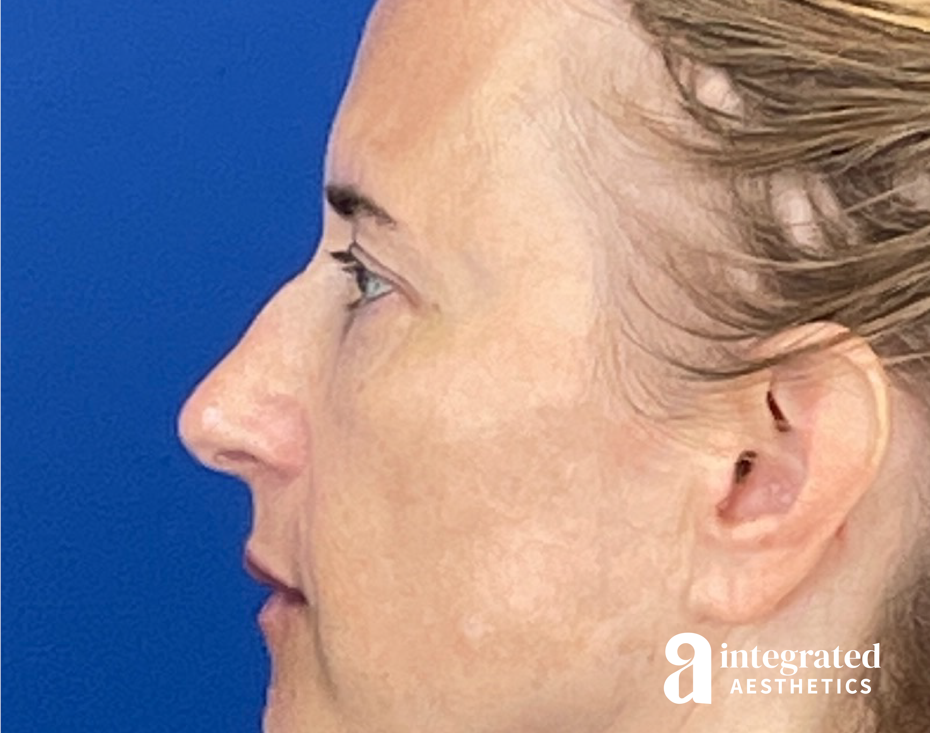 Dermal Fillers Before & After Gallery - Patient 421717 - Image 1