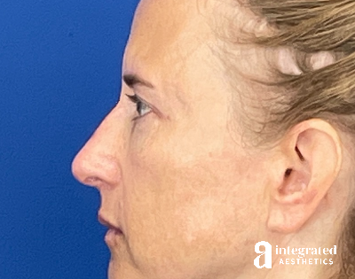 Dermal Fillers Before & After Gallery - Patient 421717 - Image 2