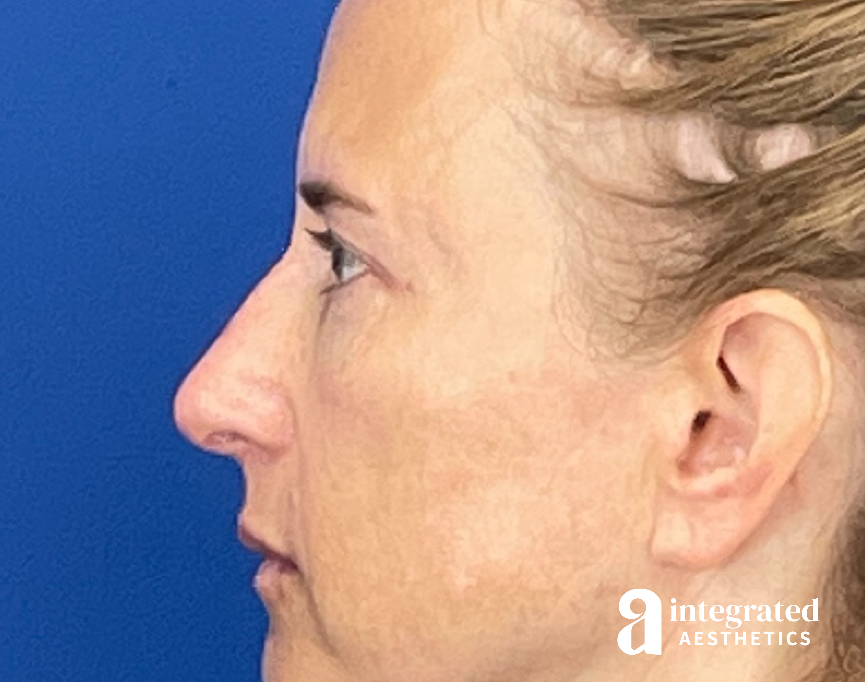 Dermal Fillers Before & After Gallery - Patient 421717 - Image 2